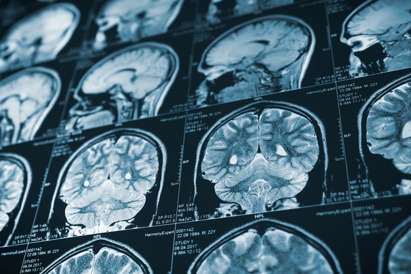 Second Impact Syndrome in California: Why a Second Head Injury Can Be Life-Threatening